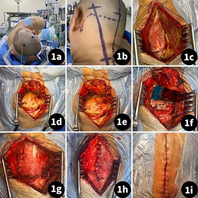 Surgical management of a foramen magnum tumor via a far-lateral approach using an oblique straight incision: a case series report and technique note